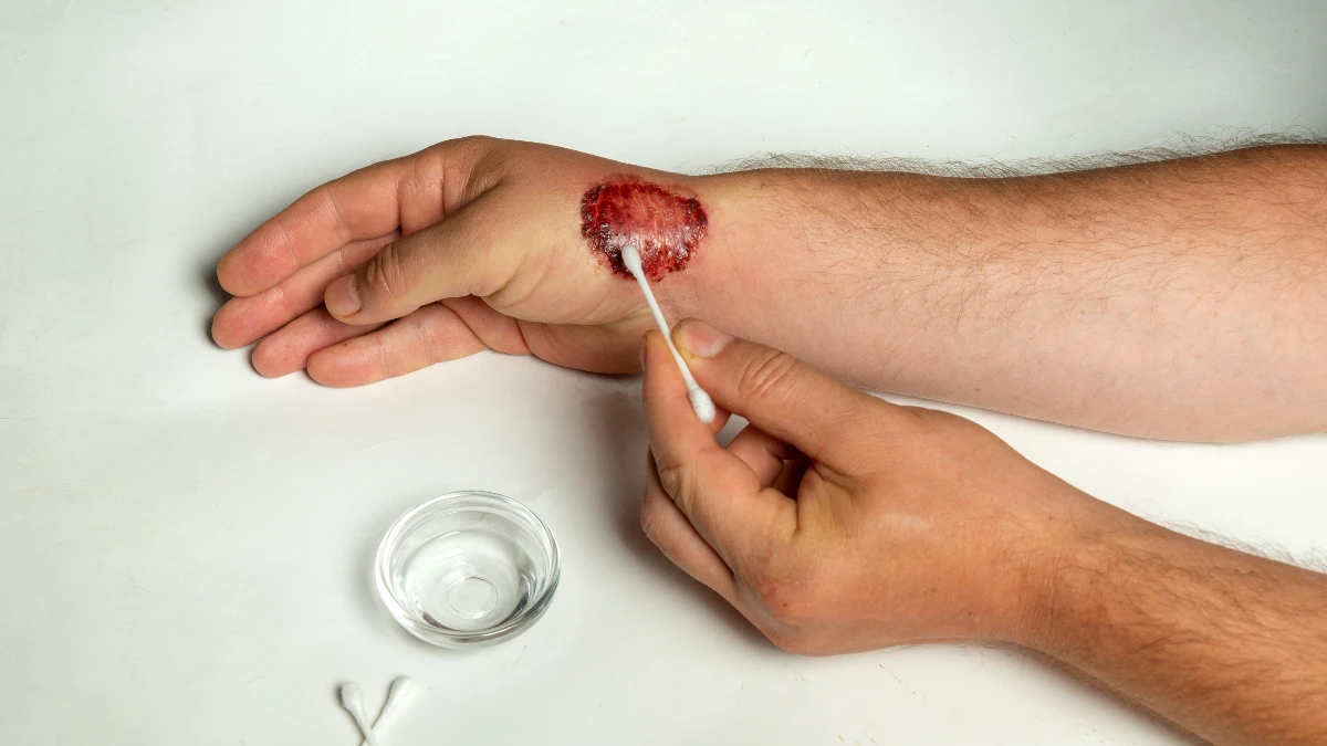 Easily Bruising or Bleeding